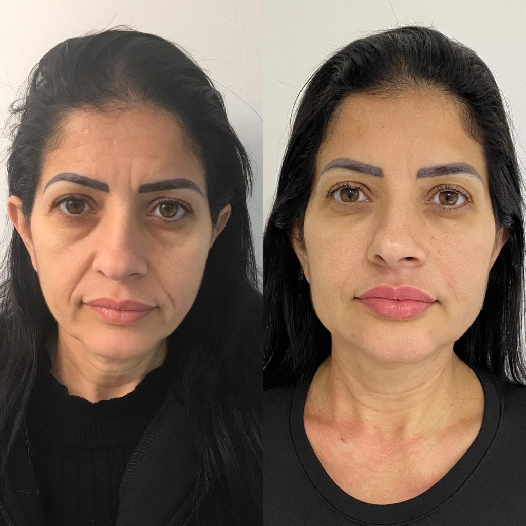 Facial harmonisation before and after, Sol Clinic London