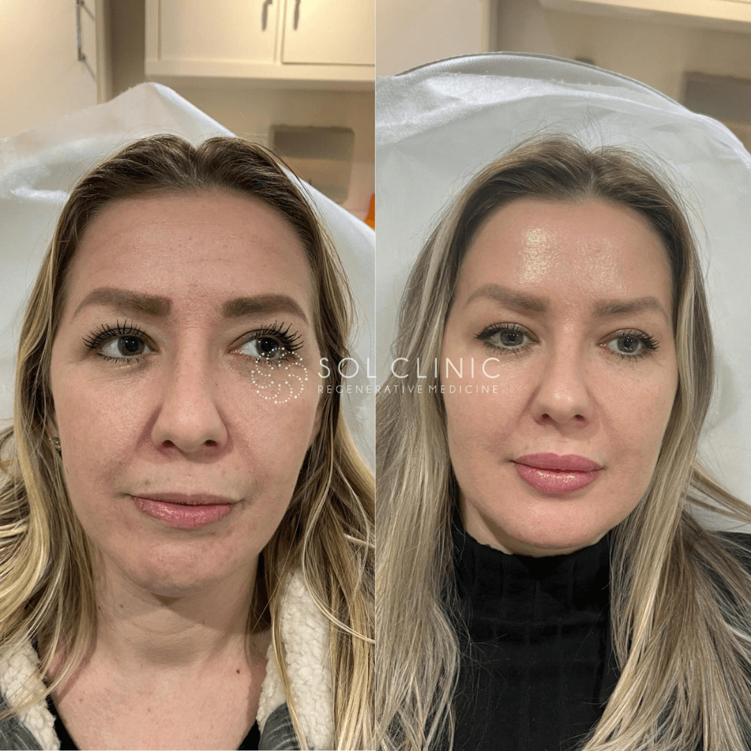 Facial harmonisation before and after, Sol Clinic London